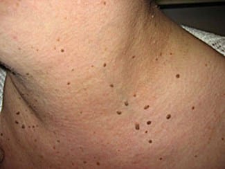 Skin Tags on Neck