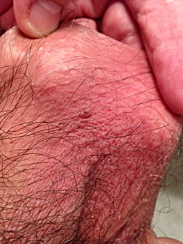Skin Tags on Testicles