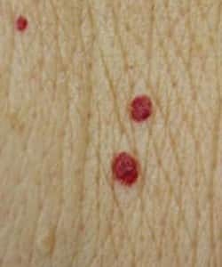 Red Skin Tags That Hurt