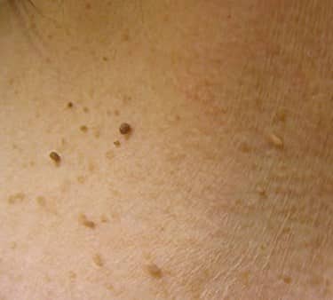 Do Skin Tags Fall Off when You Lose Weight