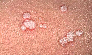 Genital Warts vs Skin Tags