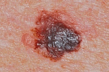 Is it a melanoma or skin tag?