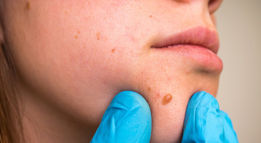 How to Remove Skin Tags Naturally