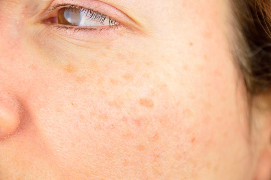 Mole vs. Freckle 10 Ways to Tell the Difference