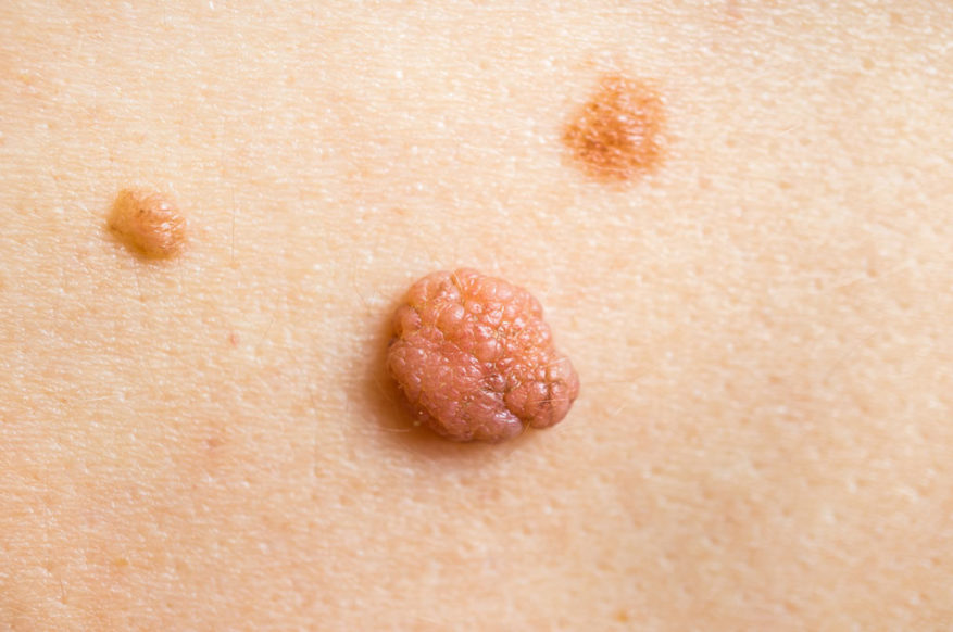 Inflamed Skin Tag What Can Be Done About It?