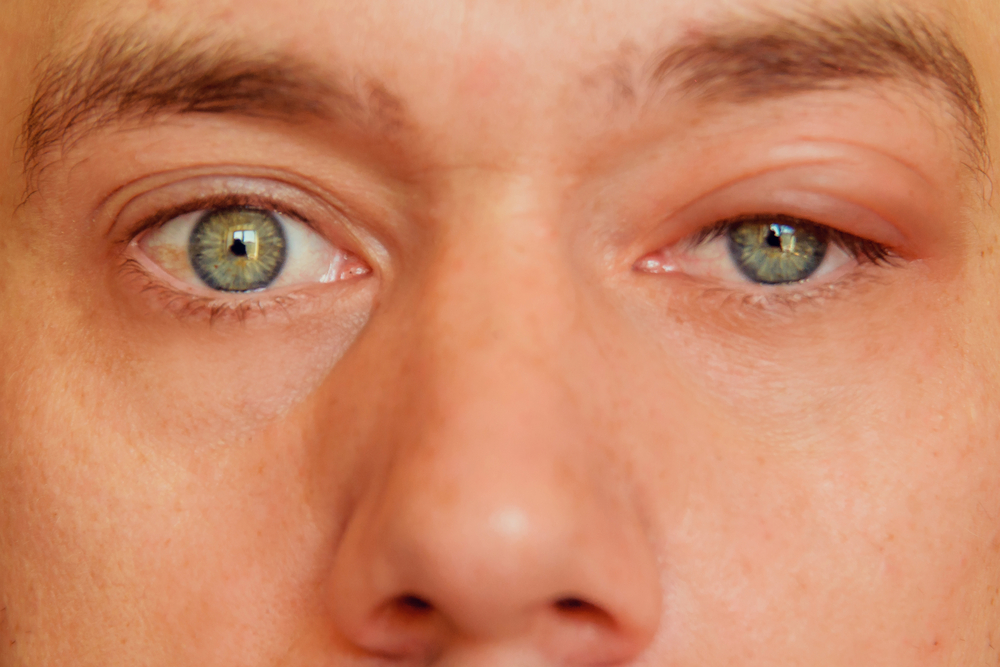 boils and styes